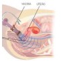 Perineal elektrostimulator för inkontinens Beac IntelliSTIM BE-28UG