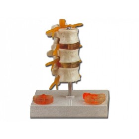 Model de patologie a herniei